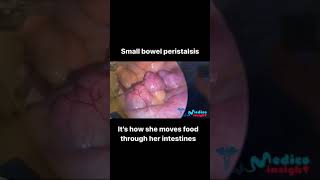 Small Bowel Peristalsis  Peristalsis  Bowel Movement  Bowel  Small Intestine [upl. by Cariotta816]