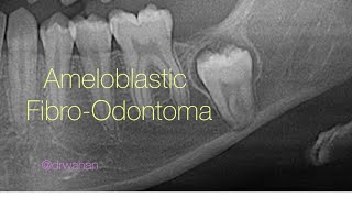 Ameloblastic FibroOdontoma Removal with Molar Extraction [upl. by Marijane266]