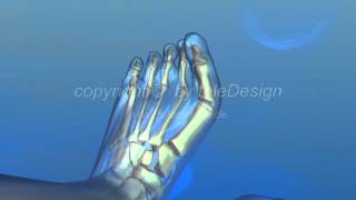 B 070 Hallux Valgus OP  PAL 169  B 070 Hallux Valgus OP  PAL 169 [upl. by Schwing]