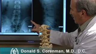 How to Read Xrays of the Lumbar Spine Lower Back  Spine Surgeon Colorado [upl. by Leban]