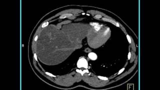 Abdomen Liver CT demonstrates a hemangioma of the liver because of the fatty infiltration1 of 10 [upl. by Ara]