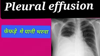 Pleural effusion ये कारण है आपके फेफड़े मे पानी भरने का। [upl. by Ostler]