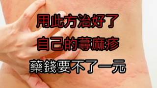 用此方治好了，自己的蕁麻疹！藥錢要不了一元 [upl. by Lubba791]