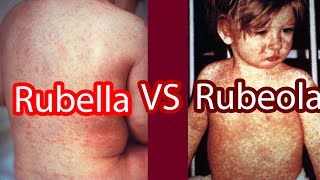 Rubella vs Rubeola Measles vs German Measles [upl. by Fleck961]