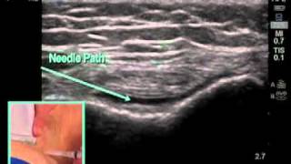 How to Ultrasound Guided Knee Injection Scanning Technique [upl. by Paine949]