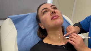 Profhilo Treatment on Face amp Neck [upl. by Issirk]