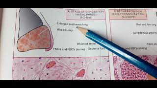 Lobar Pneumonia Revision MBBS PATHOLOGYEtiopathogenesis Gross Microscopic features complications [upl. by Rim509]