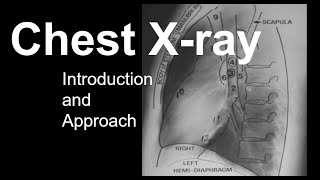 Chest Xray Introduction and Approach [upl. by Bazluke]