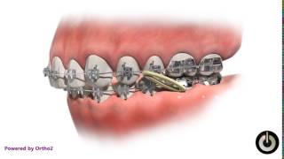 Class II Elastics  Dental Braces  Temecula Valley CA [upl. by Sibella58]