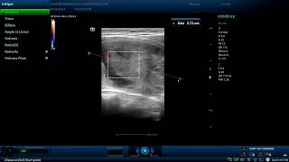 TIRADS 4 thyroid nodule  Diagnostic ultrasound cases [upl. by Joaquin]