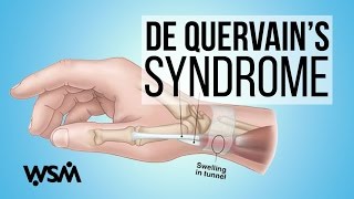 WSMs Musician Minute  De Quervains Syndrome [upl. by Maia]