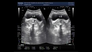 Prostatic utricle cyst or utricular cyst PUC and a Stone in the prostatic urethra with BPH [upl. by Meda]