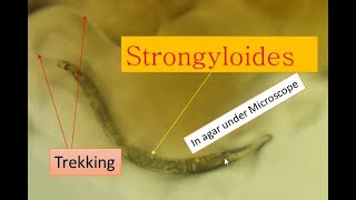 Strongyloidiasis cause and its pathogenesis Strongyloides under microscope [upl. by Irodim]