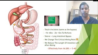 Part 5 Duodenal Switch [upl. by Eibrik]