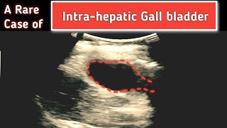 A Rare case of Intrahepatic GALL BLADDER  Ultrasound [upl. by Libna]