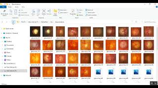 A Capsule Network based for identification of Glaucoma in retinal images [upl. by Leia271]