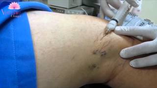 Escleroterapia de Vasinhos  Por Dr Clayton de Paula [upl. by Nattie]