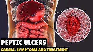 Peptic Ulcers – Causes Signs and Symptoms Diagnosis amp Treatment [upl. by Eluk]