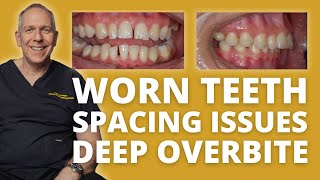 Dentistry Case Poor Aesthetics with Deep Overbite and Traumatic Occlusion [upl. by Lauri]