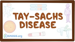 TaySachs disease  causes symptoms diagnosis treatment pathology [upl. by Yesteb]