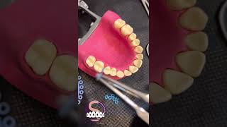 Technique for separator placement and removal dental spacersElastic separators dentist [upl. by Yenot60]