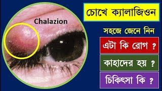 Chalazion of eye symptoms and treatment chalazion chalazioneyechalazioneyetreatment [upl. by Vonny961]