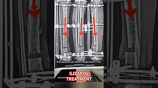 ILIZAROV TREATMENT ilizarovsurgery ytshorts [upl. by Arat]