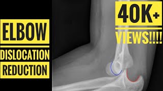 Elbow Dislocation Reduction Technique [upl. by Eelsha]