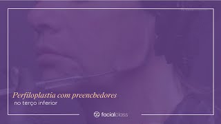 Perfiloplastia com preenchedores no terço inferior  Facial Class [upl. by Ternan]