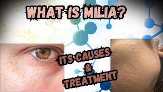 What Is Milia What Are Its Causes And Its Treatment [upl. by Asoj883]