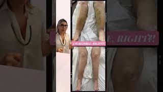 How To Treat Lipedema With Massage Treatments After LipoSuction [upl. by Hardy452]