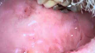 Leukoplakia oral sores part 111 [upl. by Trauts]