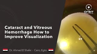 Orbit tips 035  Cataract and Vitreous Hemorrhage How to Improve Visualization [upl. by Euqnimod]