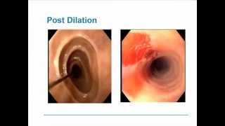 Eosinophilic Esophagitis [upl. by Blackmun]