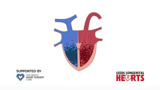 Shunting in the heart  Circulatory System and Disease  NCLEXRN  Khan Academy [upl. by O'Rourke477]