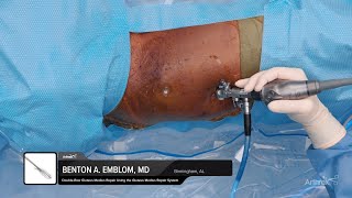 Endoscopic DoubleRow Gluteus Medius Repair Using the Gluteus Medius Repair System [upl. by Amann]