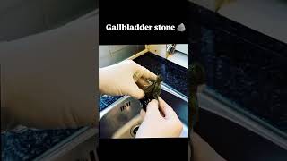 Gall bladder stonemedical shorts youtubeshorts motivation ytshorts viralshorts [upl. by Radford195]