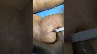 Live Sclerotherapy Watch How Its Done ✨ sclerotherapy spiderveintreatment shortsfeed shorts [upl. by Atinihc]