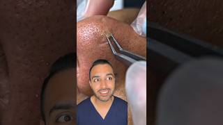 OMG I was not expecting that blackhead extraction on the nose Dr Somji reacts [upl. by Eitsud]