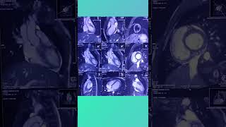 Cardiac mri view anatomy sequences [upl. by Shanon678]