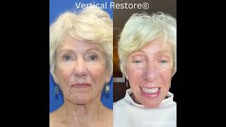 2 Weeks Facelift Healing amp Recovery Results [upl. by Maffa]