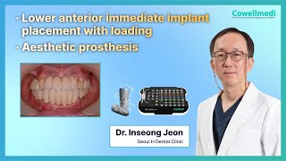 Lower anterior immediate implant placement with loadingBy DrInseong Jeon [upl. by Naaitsirhc]