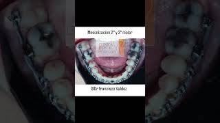 mesializacion de 2° y 3° molar en pacientes con compromiso periodontal avanzado [upl. by Deirdre]