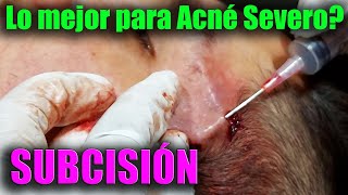 🔴 El MEJOR TRATAMIENTO para CICATRICES de ACNÉ SEVERO 😱SUBCISiÓN Nokor [upl. by Buell]