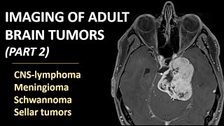 Imaging of brain tumors part 2 CNSlymphoma meningioma schwannoma and sellar tumors [upl. by Ynnaj]