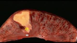 PATHOLOGY LECTURES  Hemodynamic Disorder  INFARCT [upl. by Nwahser]