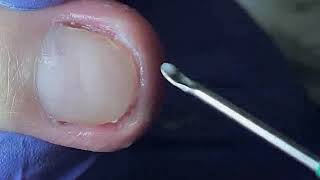 DIY Ingrown Toenail Removal  How to Safely Cut Ingrown Toenails at Home [upl. by Kai]