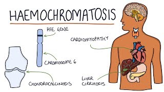 Understanding Haemochromatosis [upl. by Irrac608]