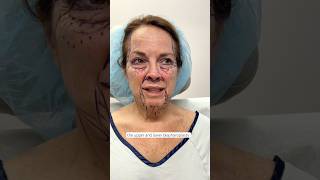 Complete Full Facial Transformation facelift plasticsurgery [upl. by Graaf768]