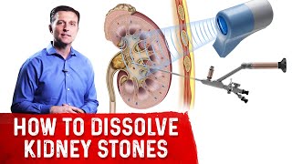 How To Dissolve Kidney Stones Explained By DrBerg [upl. by Etnoval449]